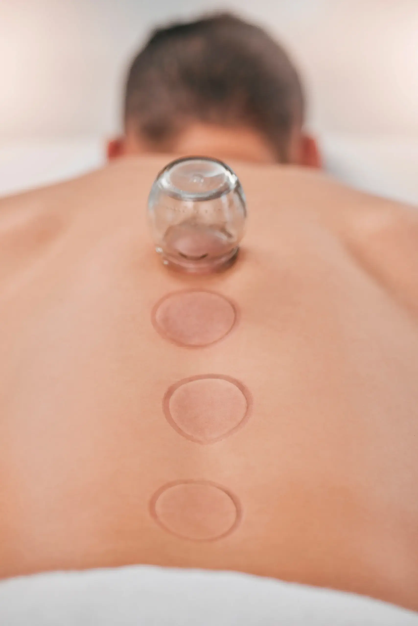 Glass cupping cup placed on a man's back with three circular suction marks along the spine